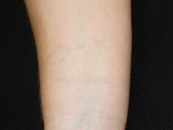 Laser Tattoo Removal Case 30 - After