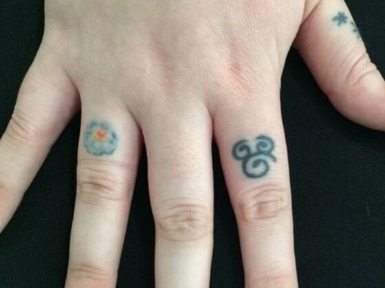 Laser Tattoo Removal Case 31 - Before