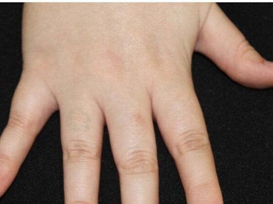 Laser Tattoo Removal Case 31 - After