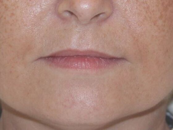 Injectables Case 39 - Before