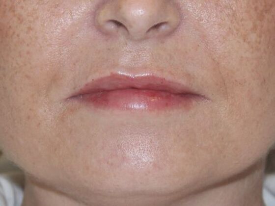 Injectables Case 39 - After