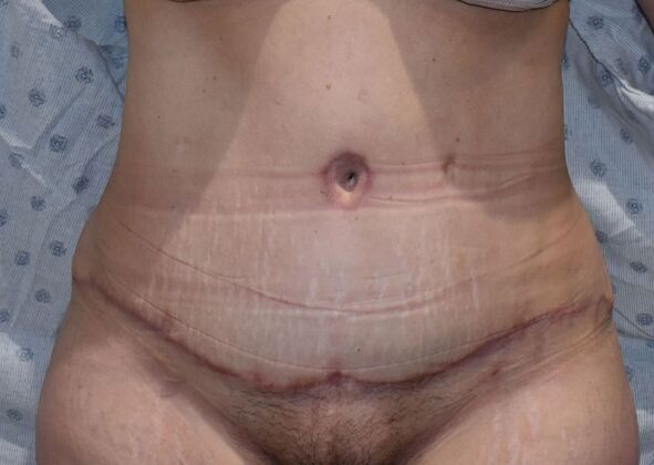 Tummy Tuck (Abdominoplasty): Case 407 - After