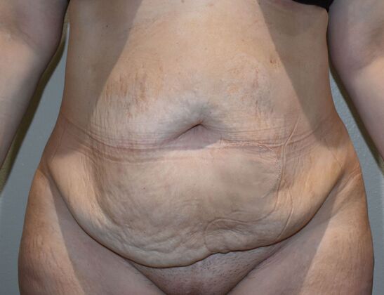 Tummy Tuck (Abdominoplasty): Case 407 - Before