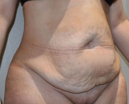 Tummy Tuck (Abdominoplasty): Case 407 - Before