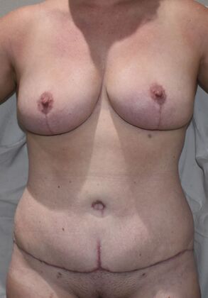 Mommy Makeover Case 265 - After