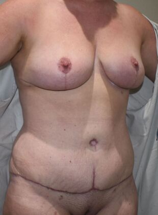 Mommy Makeover: Case 265 - After