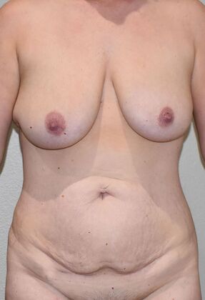 Mommy Makeover Case 265 - Before