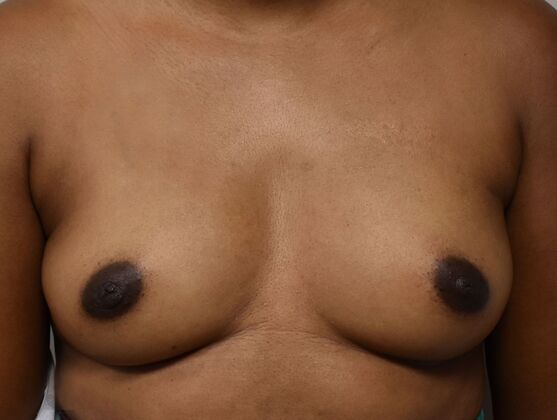 Breast Augmentation w/ Lift Case 481 - Before