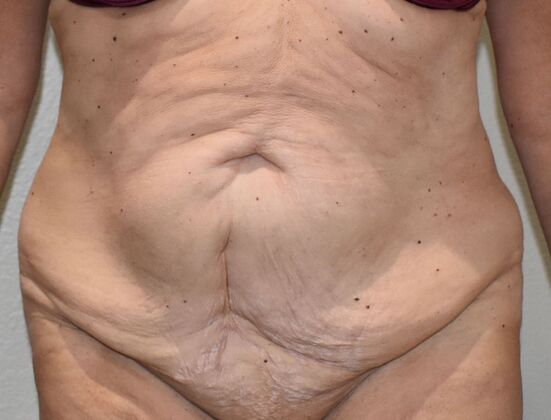 Tummy Tuck (Abdominoplasty): Case 408 - Before