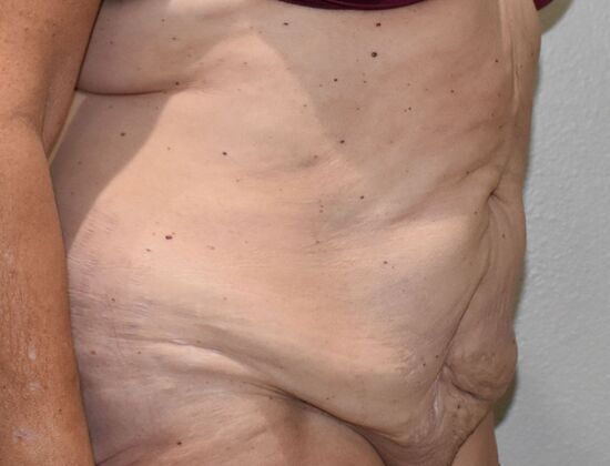 Tummy Tuck (Abdominoplasty): Case 408 - Before