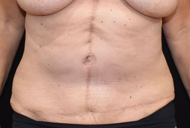 Tummy Tuck (Abdominoplasty): Case 408 - After