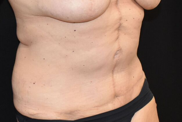 Tummy Tuck (Abdominoplasty): Case 408 - After