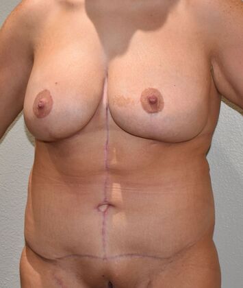 Massive Weight Loss : Case 127 - After