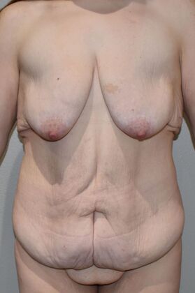 Massive Weight Loss : Case 127 - Before