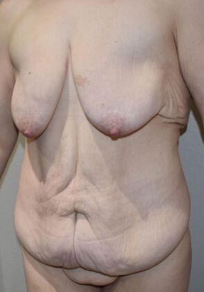 Massive Weight Loss : Case 127 - Before