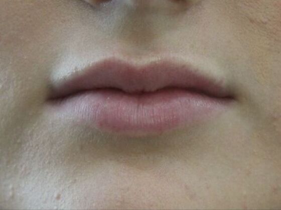 Injectables Case 40 - Before