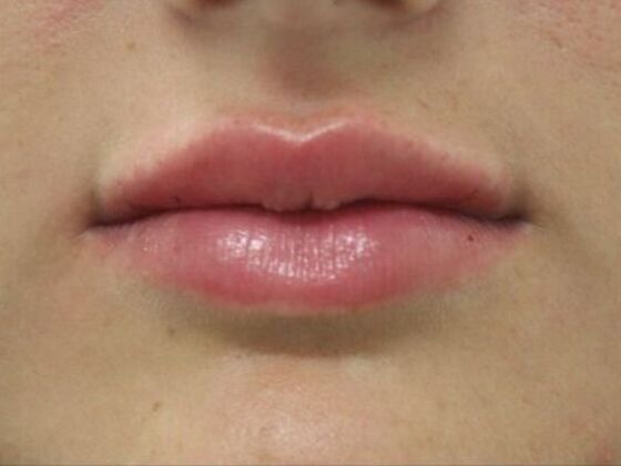 Injectables Case 40 - After