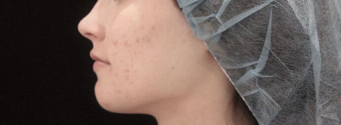 Skin Treatments: Case 3 - After