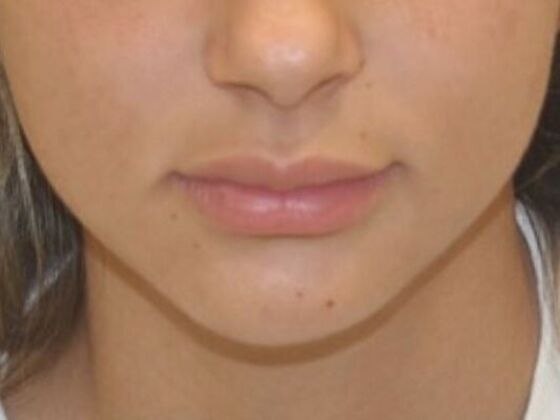 Injectables Case 41 - Before
