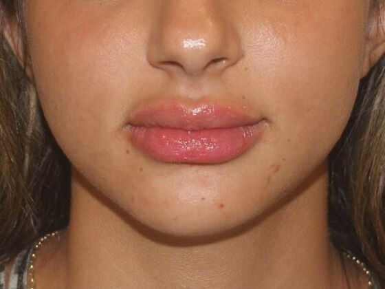 Injectables Case 41 - After