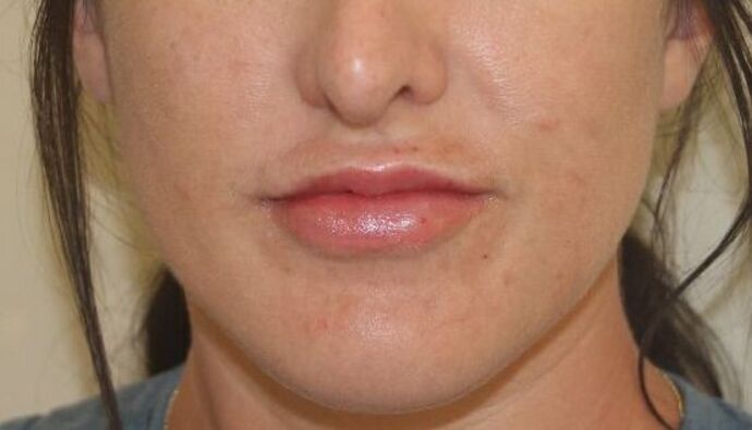 Injectables Case 42 - After