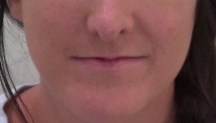 Injectables Case 42 - Before