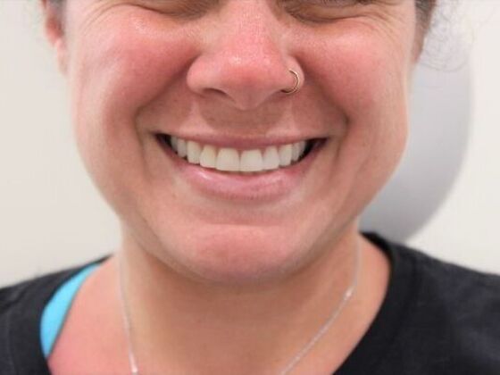 Injectables Case 43 - Before