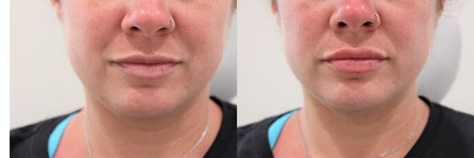 Injectables: Case 43 - Before