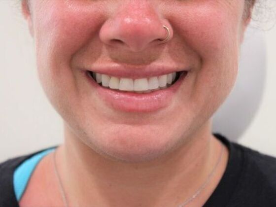 Injectables Case 43 - After