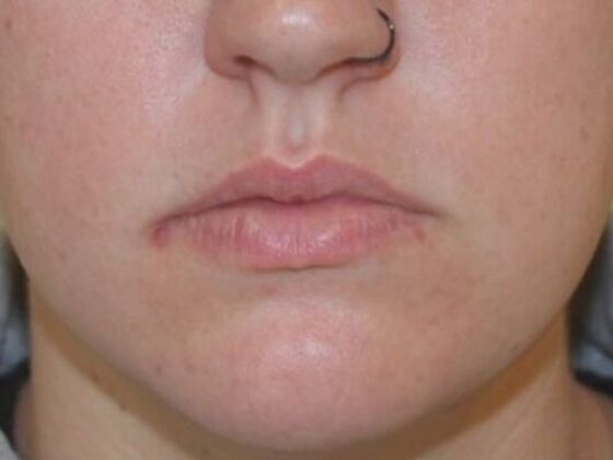 Injectables Case 44 - Before