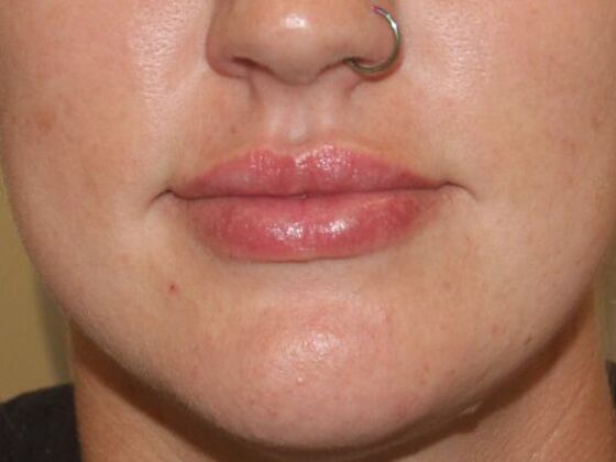 Injectables Case 44 - After