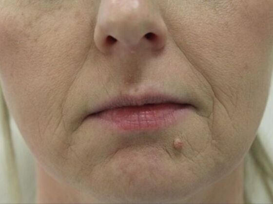 Injectables Case 45 - Before