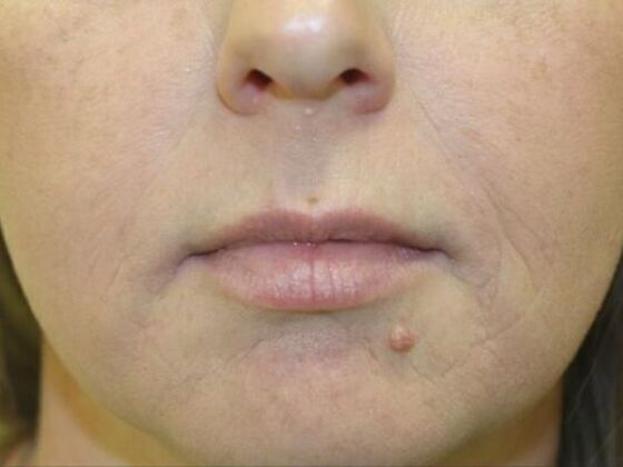 Injectables Case 45 - After