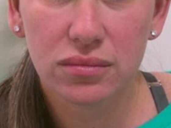 Injectables Case 46 - Before