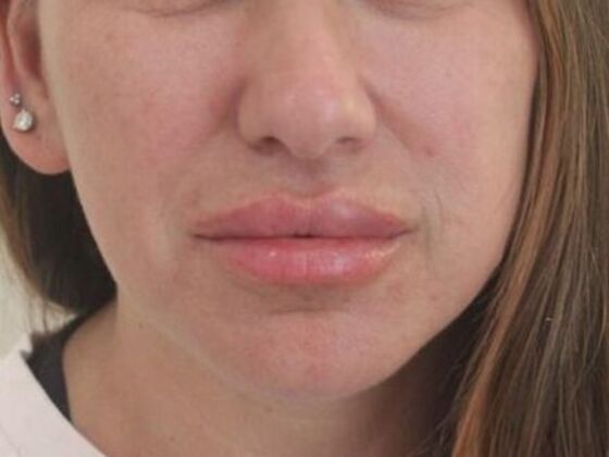 Injectables Case 46 - After