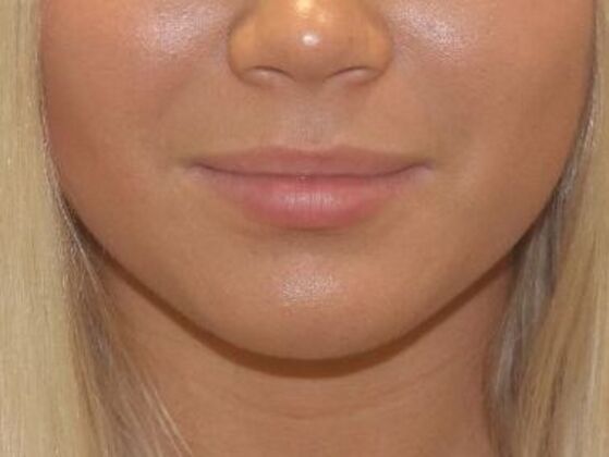 Injectables Case 47 - Before