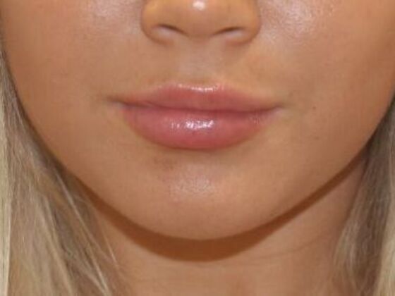 Injectables Case 47 - After