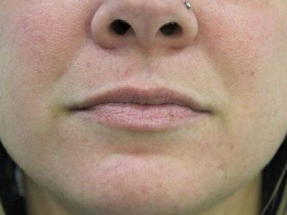 Injectables Case 48 - Before