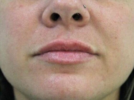 Injectables Case 48 - After