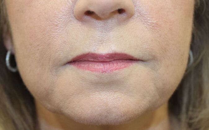 Injectables Case 49 - After