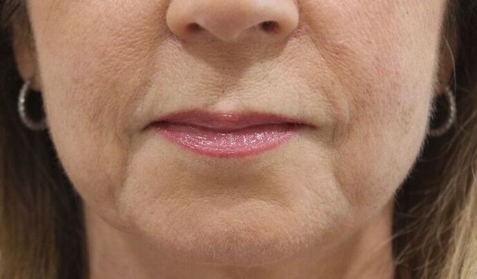 Injectables Case 49 - Before