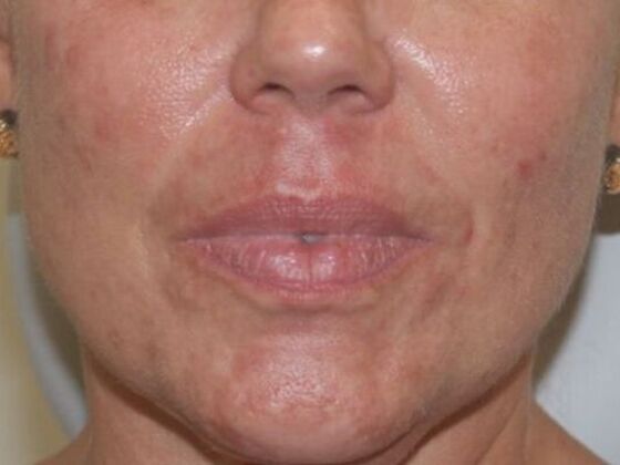 Injectables Case 50 - Before