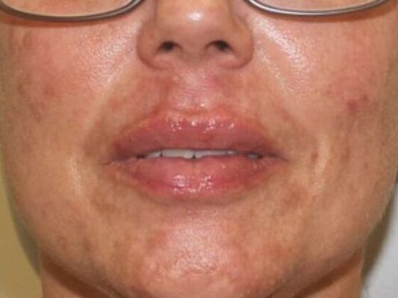 Injectables Case 50 - After