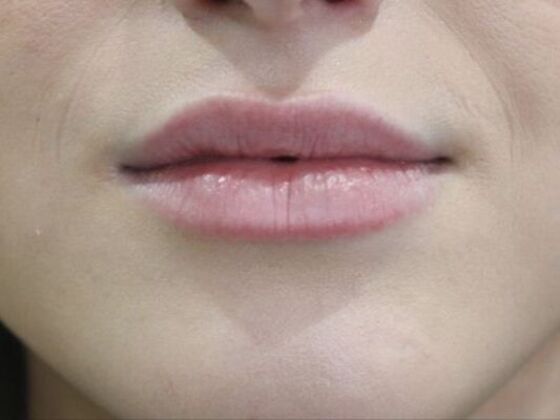 Injectables Case 52 - Before