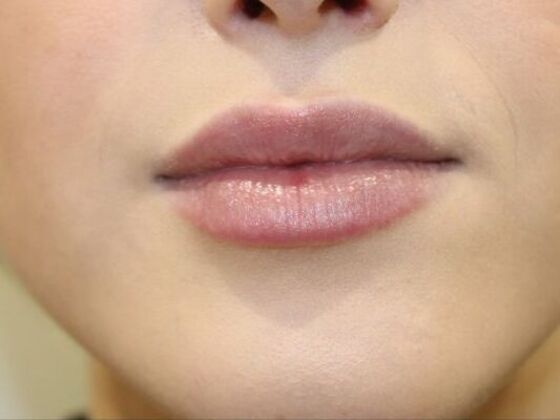 Injectables Case 52 - After