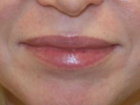 Injectables Case 53 - Before