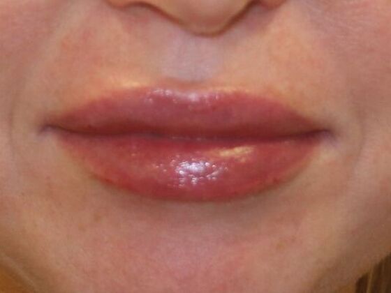 Injectables Case 53 - After