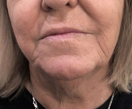 Injectables Case 54 - Before