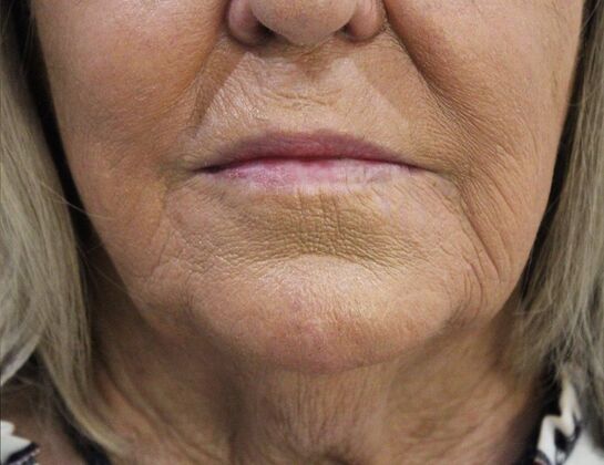 Injectables Case 54 - After