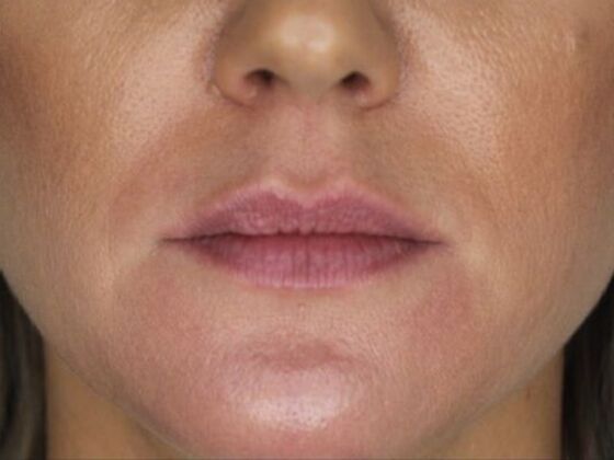 Injectables Case 55 - Before